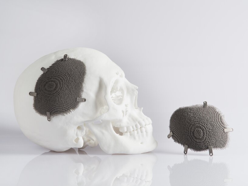 3D printing in medical technology cranial implant EOS GmbH EOS GmbH